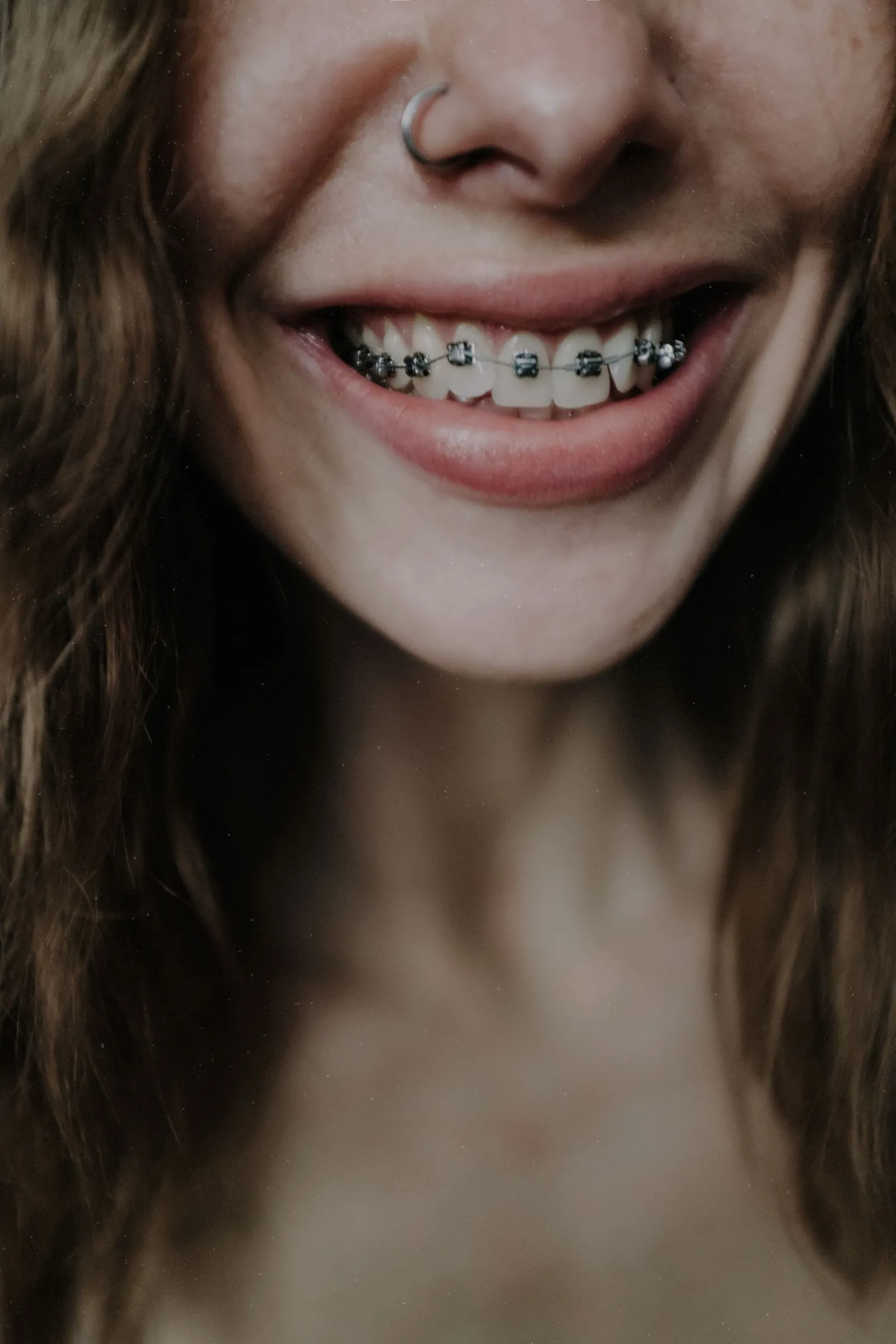 A close view of metal braces on the upper teeth.