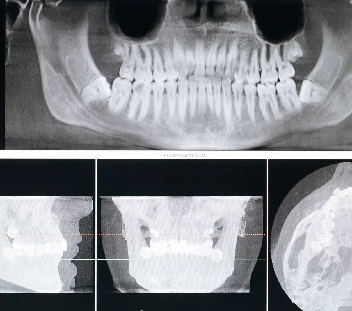 A panoramic radiograph and CBCT slices of a jaw.